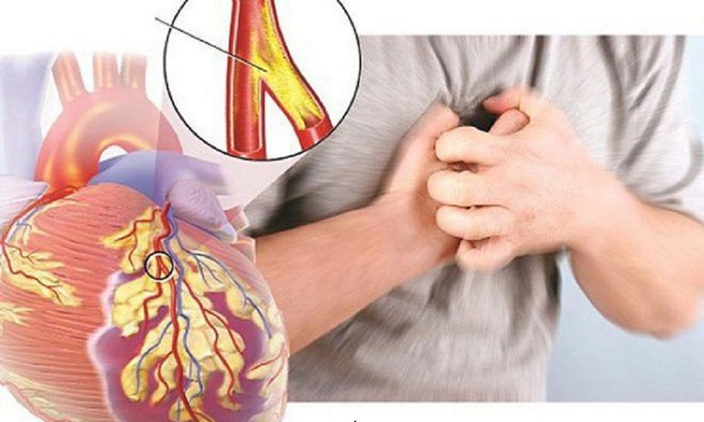 Khuyến cáo về hội chứng động mạch vành mạn