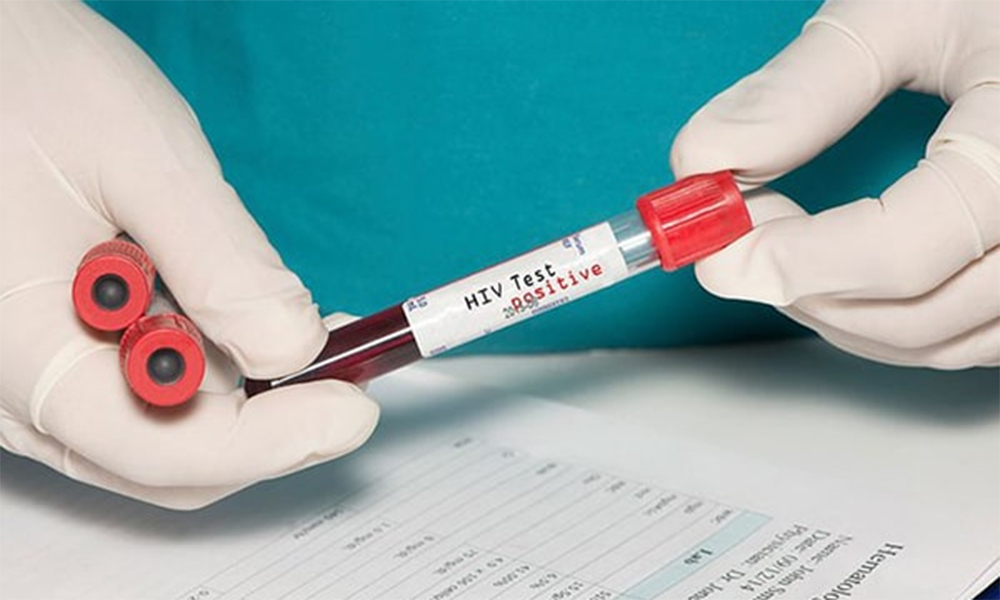 Xét nghiệm tải lượng virus HIV được quỹ BHYT chi trả